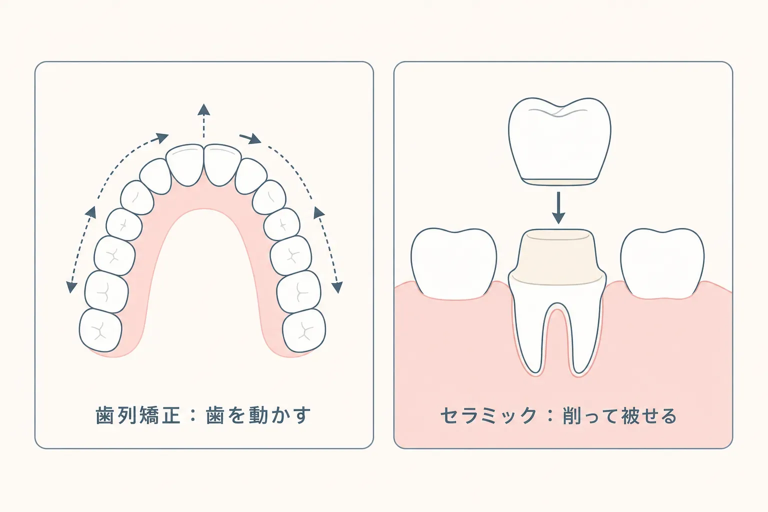 「セラミック矯正」とは？歯を削るリスクと本来の歯列矯正との違いを正直に解説の解説イラスト