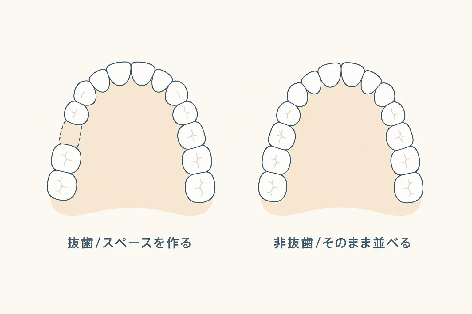 横顔（Eライン）を変える矯正の比較｜抜歯・非抜歯で口元の変化はどう違う？の解説イラスト