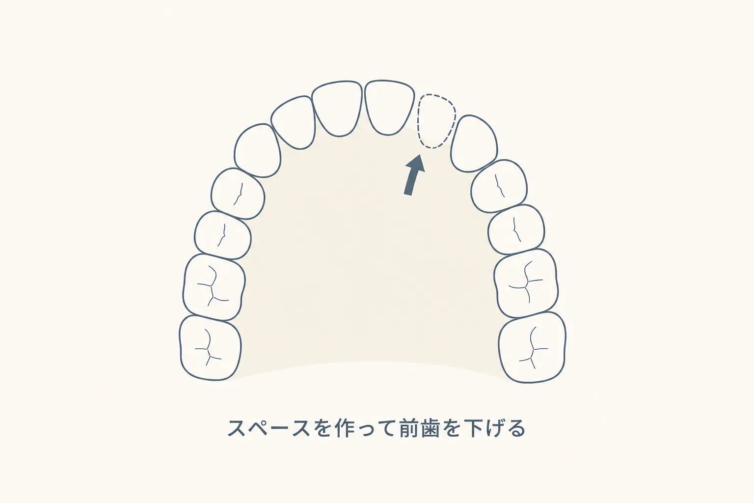 口ゴボを治す治療法の比較｜歯列矯正 vs セットバック（外科）効果とリスクの違いの解説イラスト