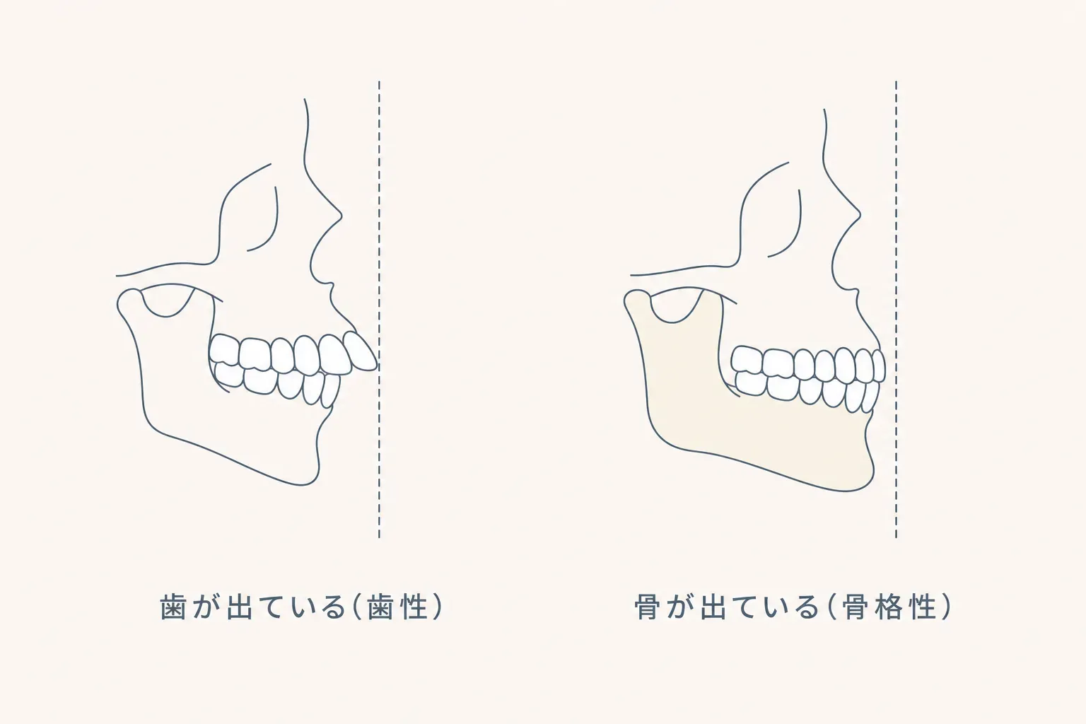 出っ歯（上顎前突）のセルフチェック｜歯が出ている？骨が出ている？タイプ別の見分け方の解説イラスト