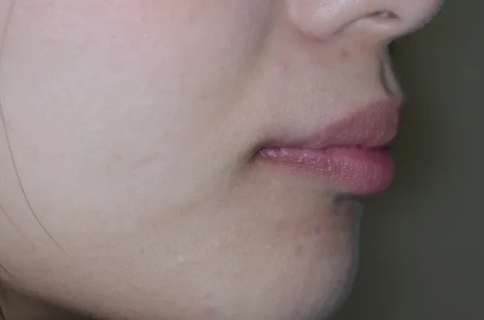 鼻先とあご先を結んだEラインに対して口元が前に出て見える横顔の例