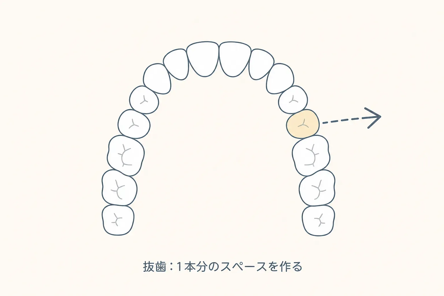 矯正で「抜歯」は必要？抜く・抜かないの判断基準とメリット・デメリットを解説の解説イラスト