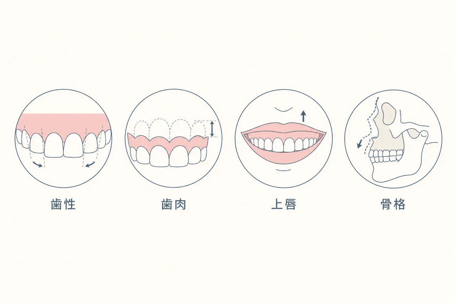 ガミースマイルの原因と治し方｜矯正で治る？費用・期間も解説の解説イラスト