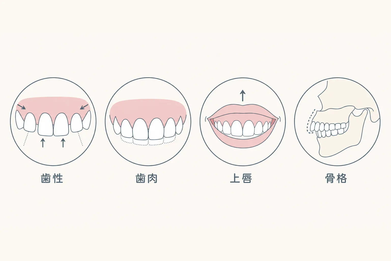 ガミースマイルのセルフチェック｜重症度の基準は？鏡でできる原因（歯・骨・唇）の見分け方の解説イラスト