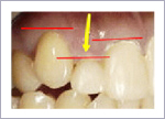 短い歯を長くする歯周形成外科の前