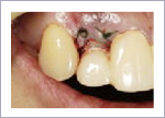短い歯を長くする歯周形成外科の処置中