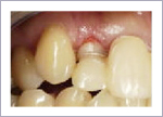 短い歯を揃えた歯周形成外科後　歯ぐきが落ち着いた状態