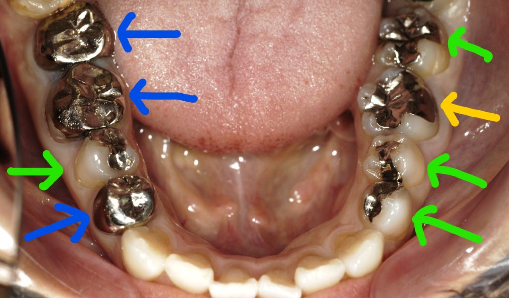奥歯の銀歯を白い歯にするときの治療の選択肢