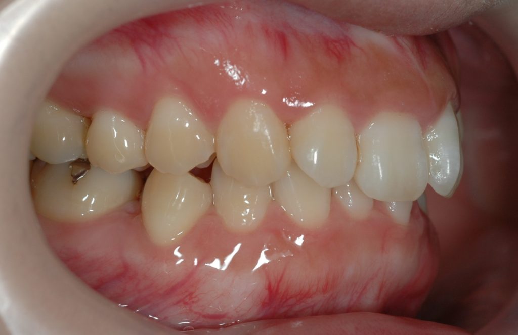 ガミースマイルの矯正前の歯並び