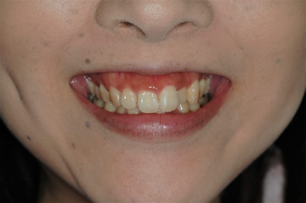 笑うと歯ぐきが大きく見えるガミースマイルの矯正前
