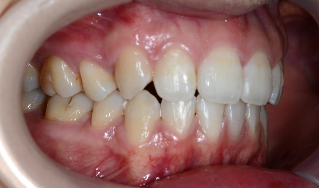 ガミースマイル矯正後の歯並び