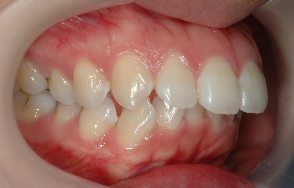 ガミースマイル矯正前の歯並び