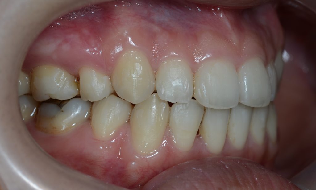 ガミースマイル矯正後の歯並び