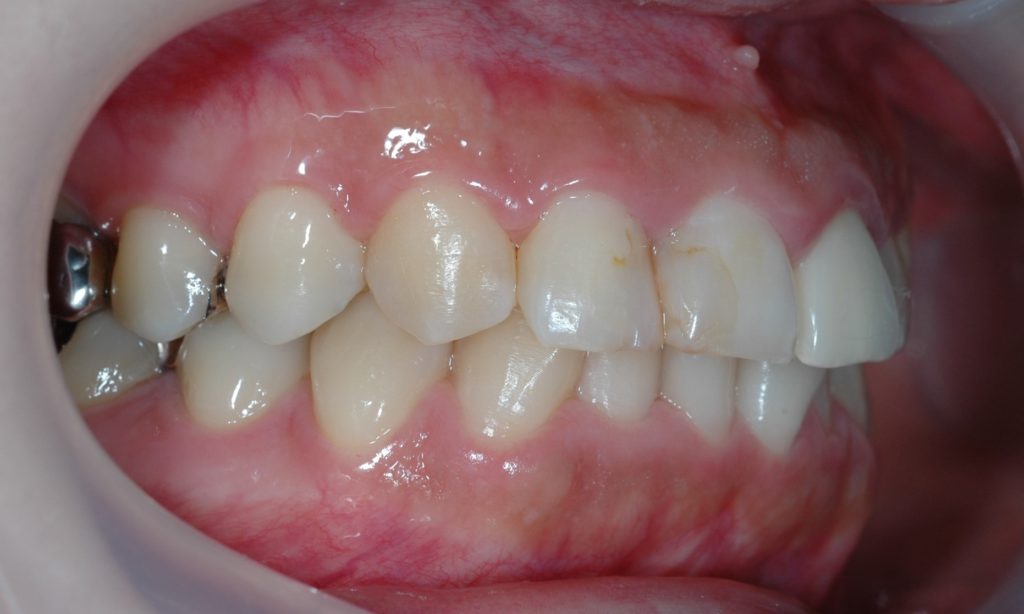 ガミースマイルの矯正前の歯並び