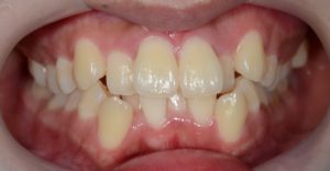 叢生の治療前の歯並び