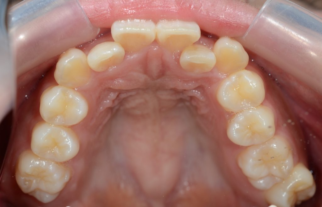 叢生の治療前の歯並び