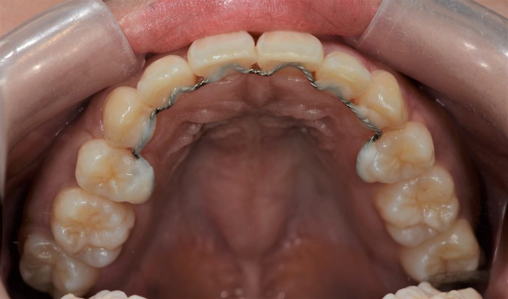 叢生の治療後の歯並び