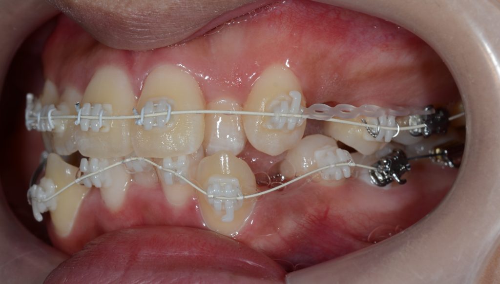 叢生を治すために抜歯してマルチブラケットシステムを歯の表面に接着