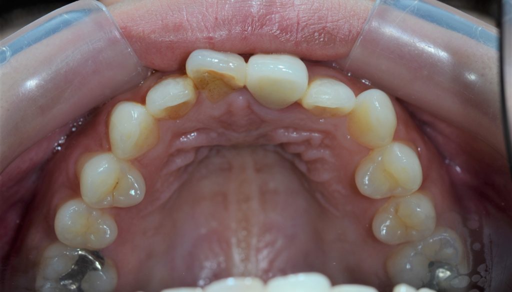 審美歯科の治療前の歯