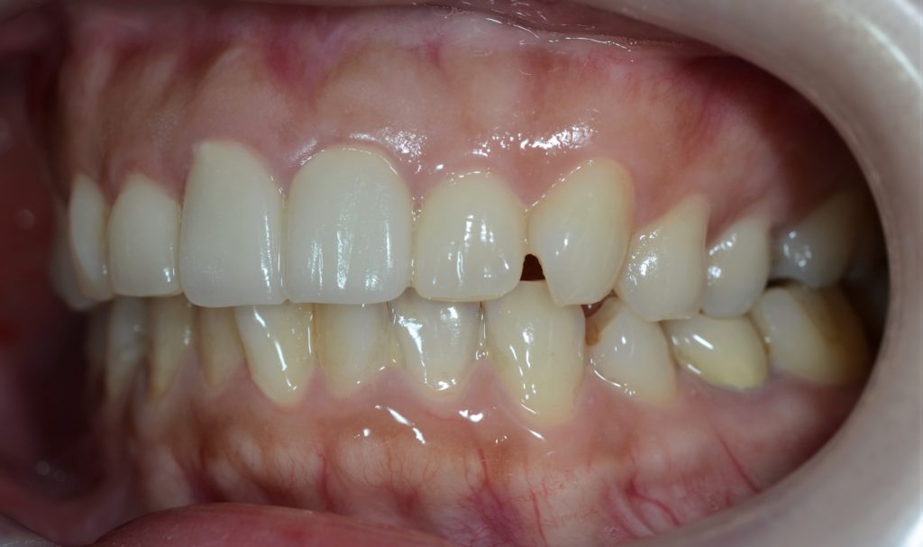 審美歯科の治療後の歯