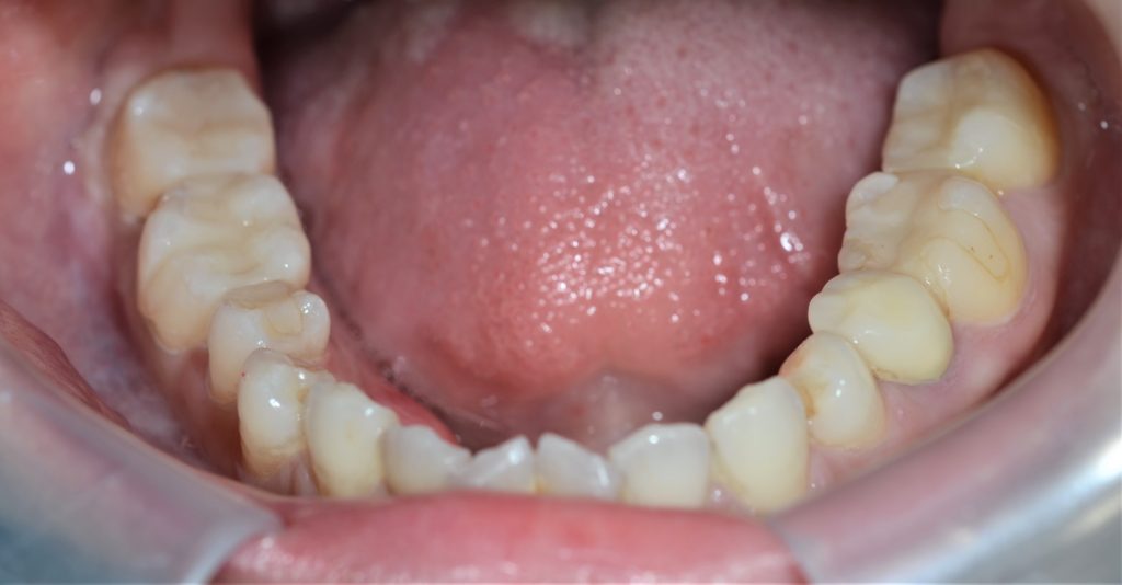 審美歯科の治療後の歯