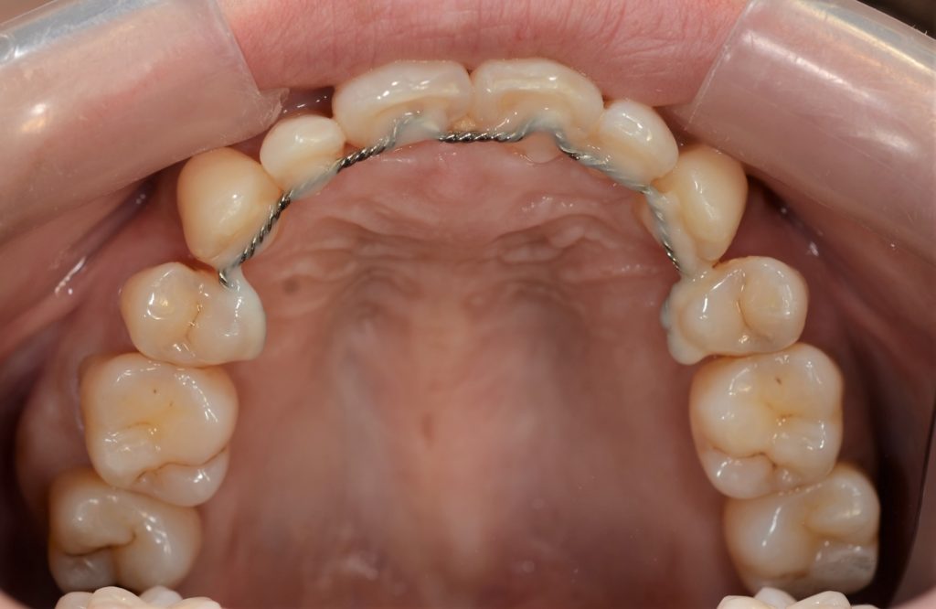 前歯のガタガタを矯正した後の歯並び