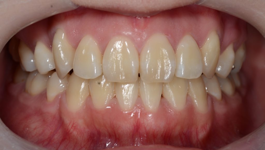 八重歯の矯正後の歯並び