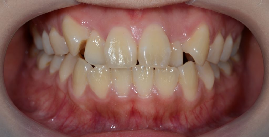 八重歯の矯正前の歯並び