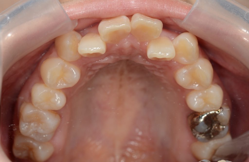 八重歯の矯正前の歯並び