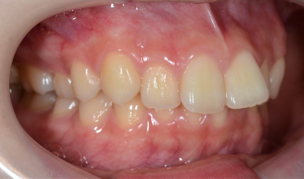 出っ歯を矯正する前の歯並び