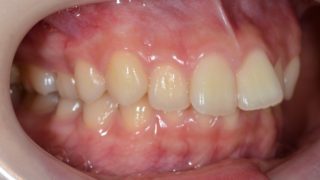 出っ歯を矯正する前の歯並び
