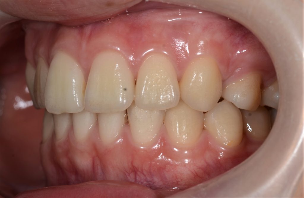 出っ歯を矯正した後の歯並び