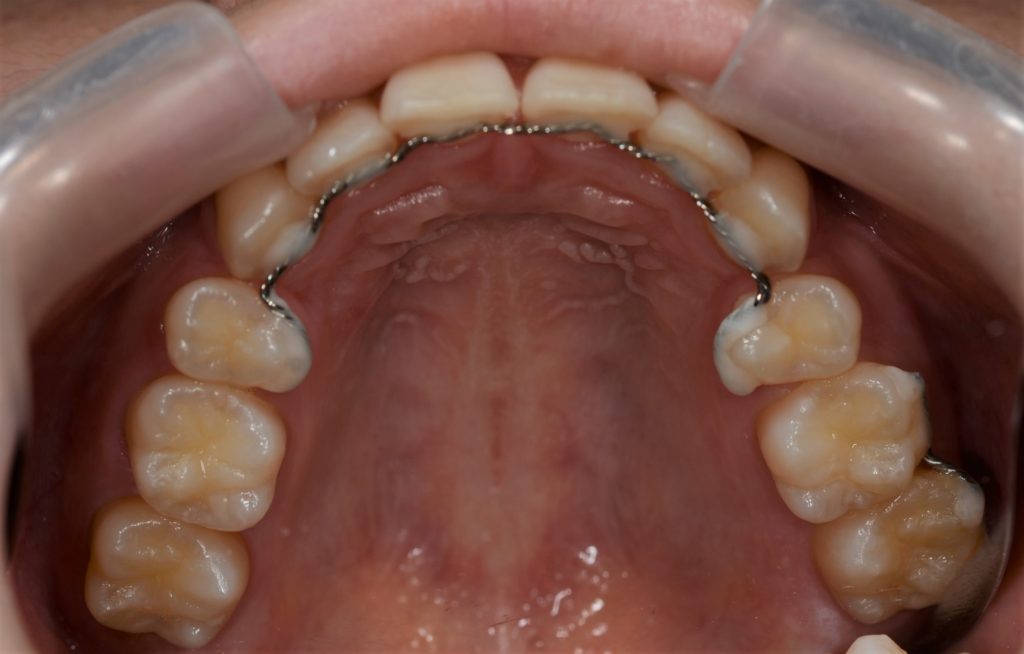 出っ歯を矯正した後の歯並び