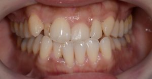 前歯のガタガタを矯正する前の歯並び