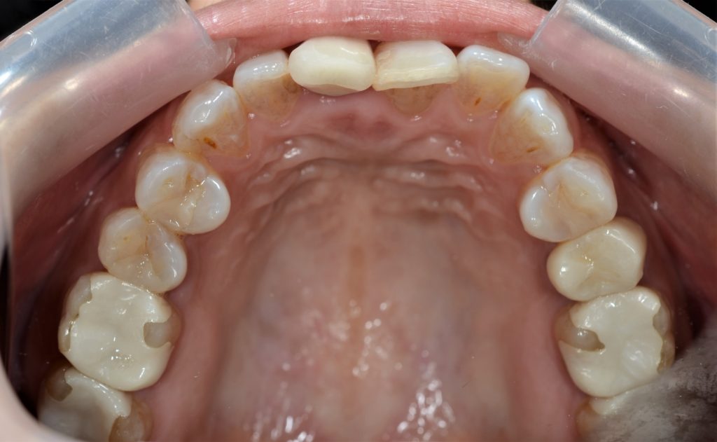 マウスピース矯正後の歯並び