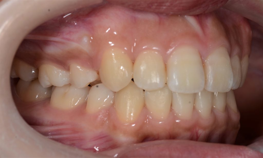 出っ歯に見える上下顎前突を矯正した後の歯並び