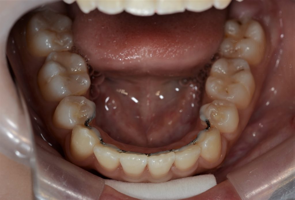 出っ歯に見える上下顎前突を矯正した後の歯並び