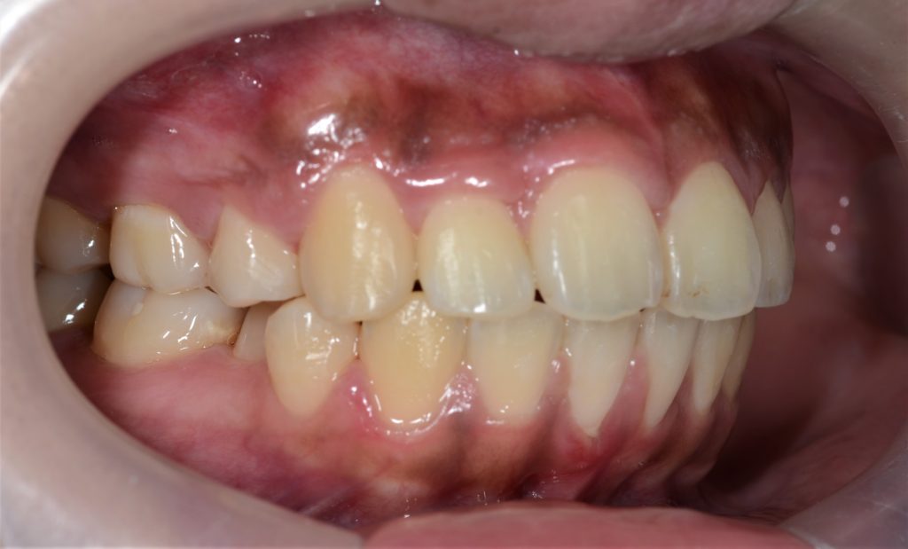 八重歯と出っ歯を治した後の歯並び