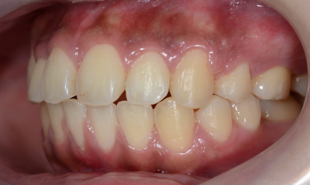 八重歯と出っ歯を治した後の歯並び