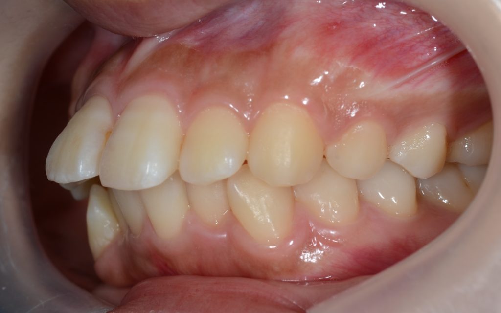 出っ歯に見える上下顎前突を矯正する前の歯並び