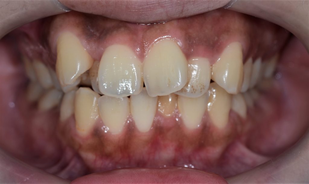 八重歯と出っ歯を治す前の歯並び
