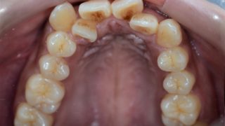 八重歯と出っ歯を治す前の歯並び