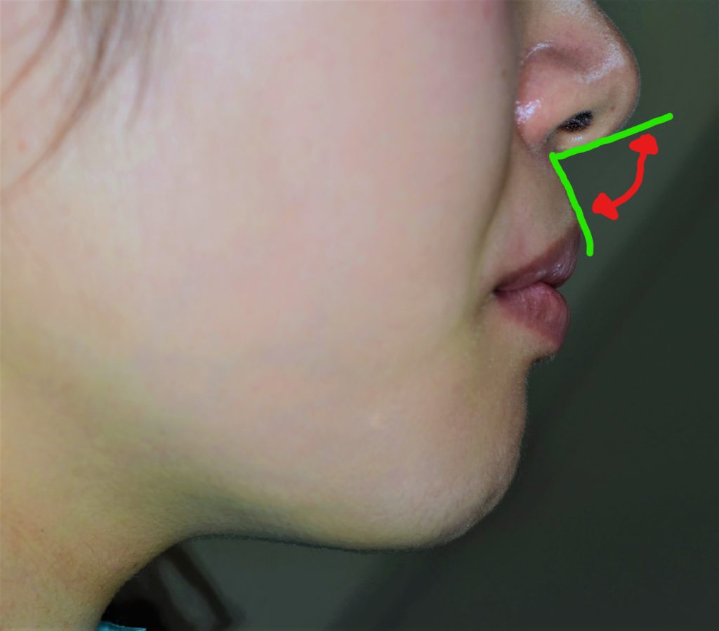 唇・鼻の評価の指標である鼻唇角