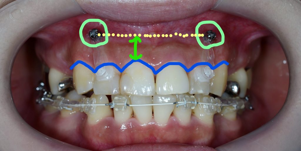 圧下の時の歯と歯茎の変化（治療前）