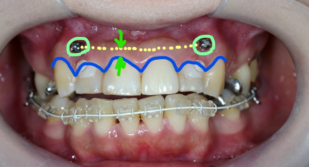 圧下の時の歯と歯茎の変化（治療後）