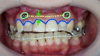 圧下の時の歯と歯茎の変化（治療後）