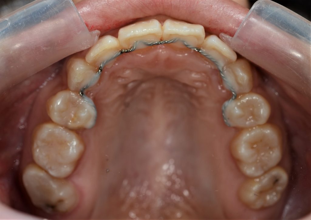 前歯が出てるのを治した矯正後の歯並び