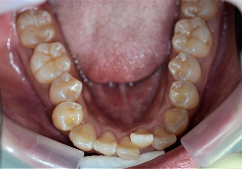 前歯のガタガタを矯正する前の歯並び