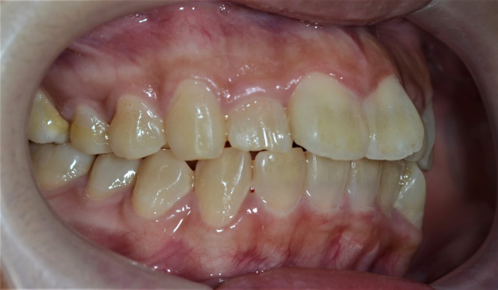 前歯が出てるのを治す矯正前の歯並び