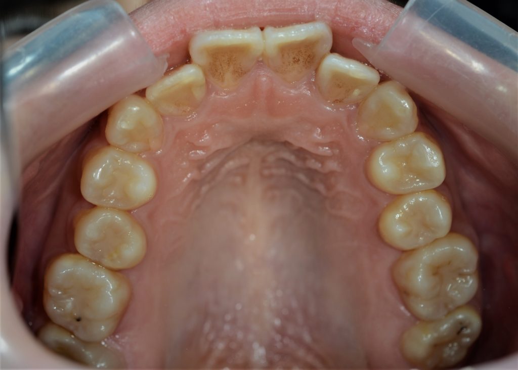 前歯が出てるのを治す矯正前の歯並び